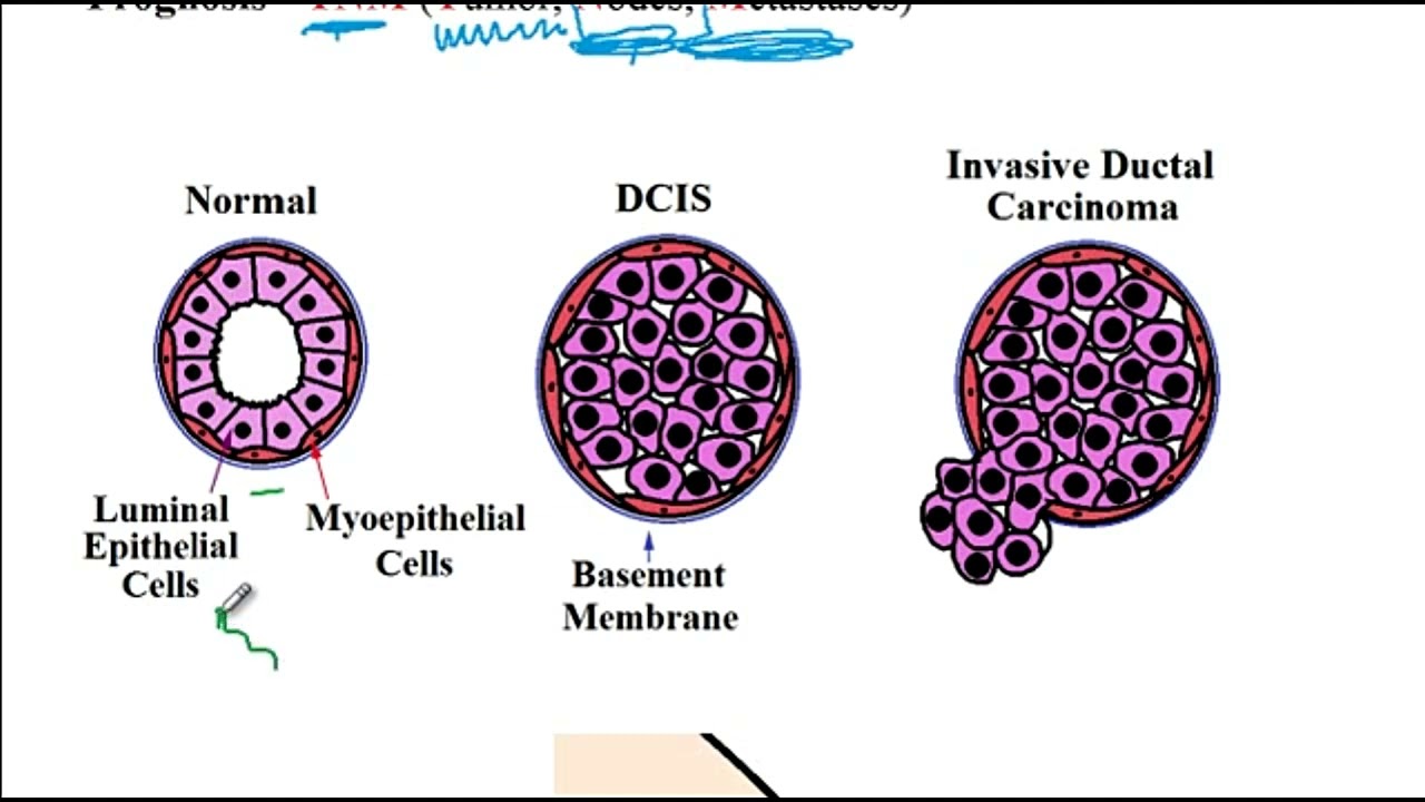 USMLE ACE Video 261: Breast Pathologies - Common Benign Disorders and Malignant Tumors