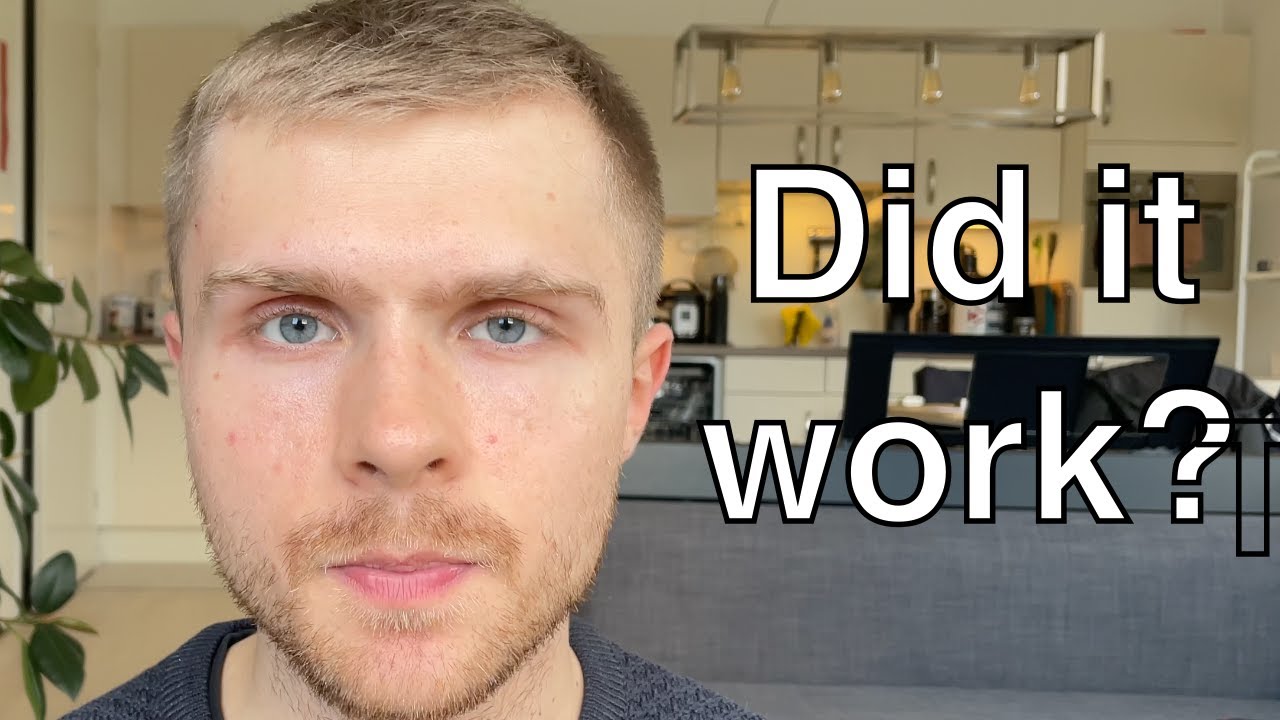 1.5 years after Accutane: Did it work?