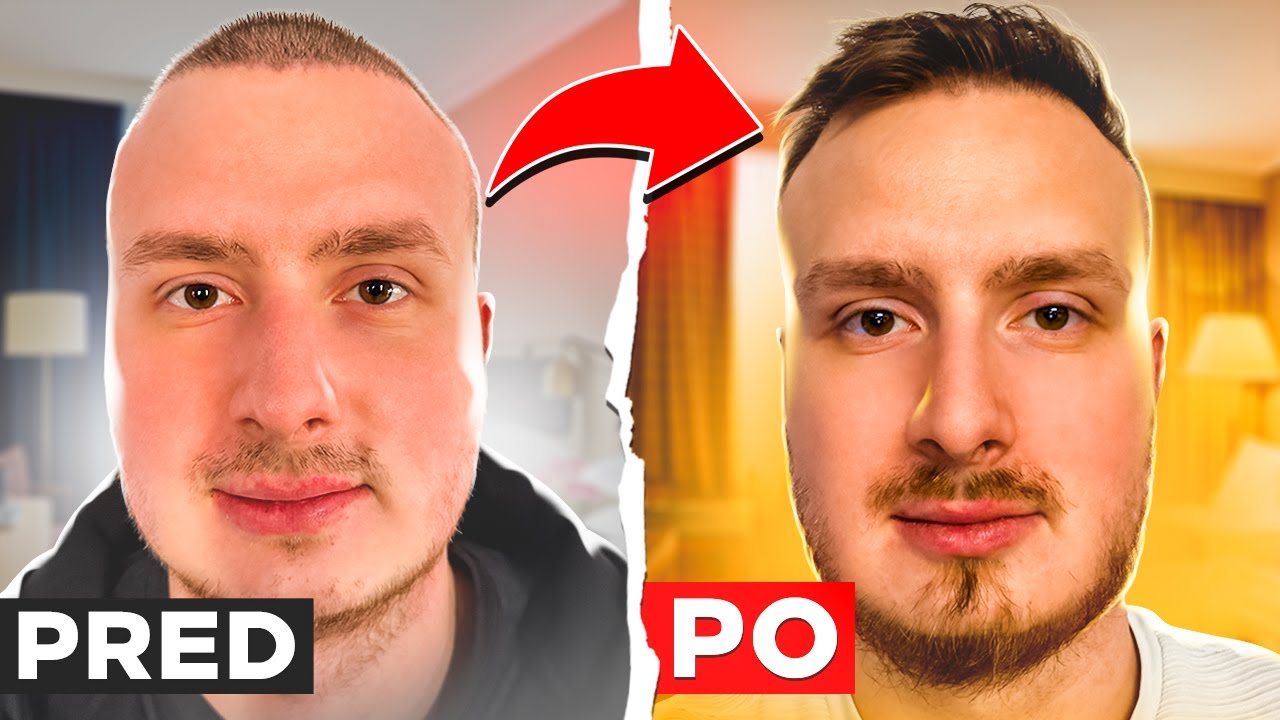 Transplantácia Vlasov po Roku