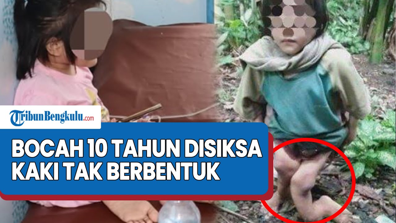 Nestapa Bocah 10 Tahun Diduga Patah Kaki akibat Dianiaya Keluarga Pamannya di Nias Hingga 