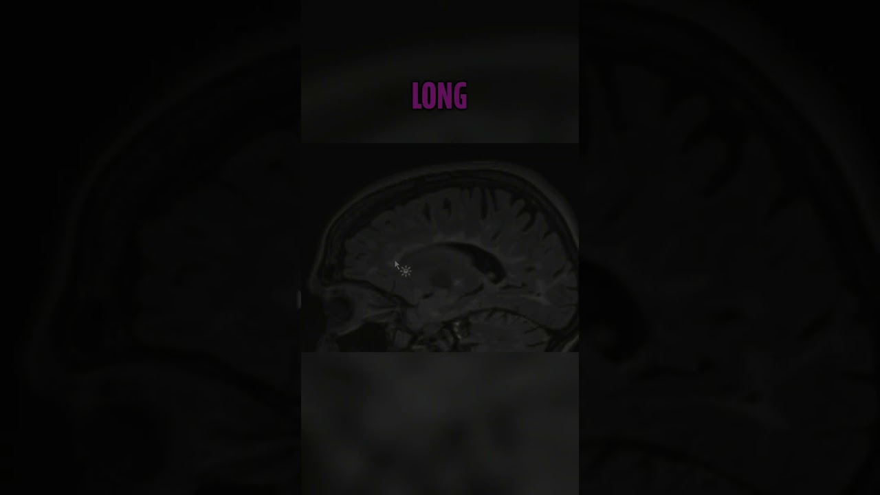 Multiple Sclerosis  MRI Shows Severe Brain Damage