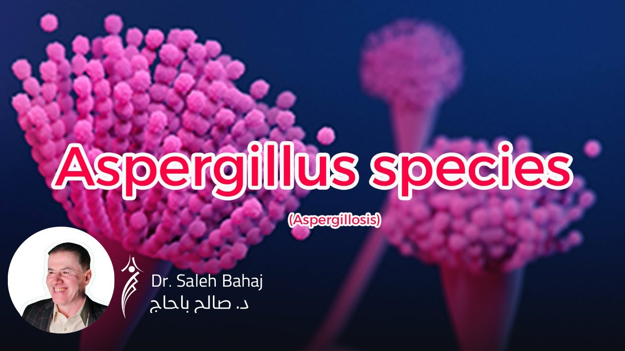 17. Aspergillus species (Aspergillosis)
