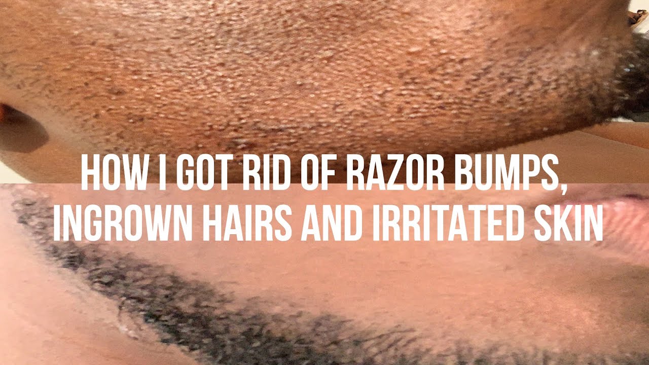 HOW I GOT RID OF RAZOR BUMPS AND INGROWN HAIRS