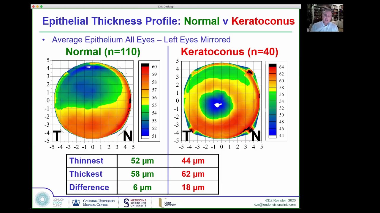 Keratoconus Screening by Tomography and Epithelial mapping - State of the Art in 2021