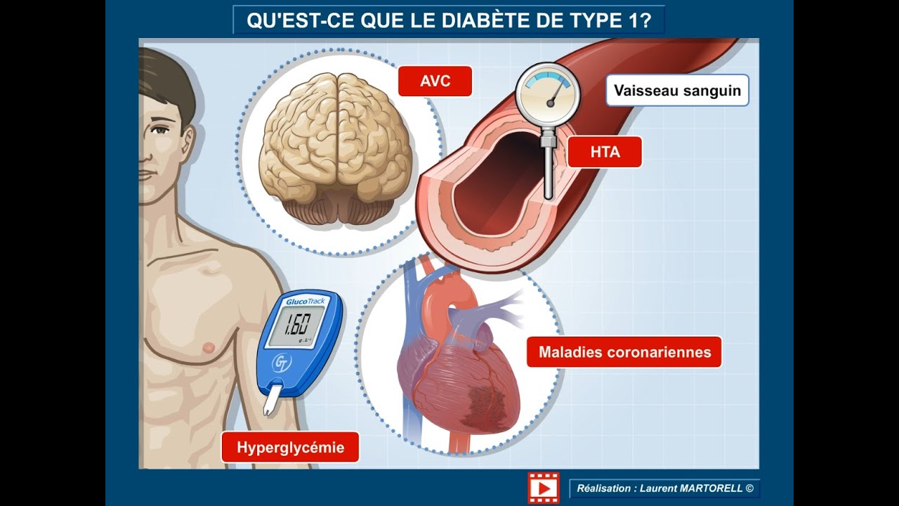 ✅ Tout savoir et comprendre sur le diabète de type 1!