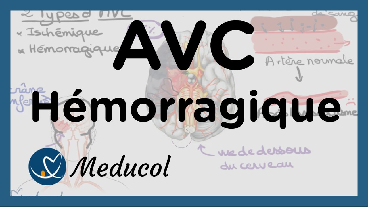 AVC Hémorragique et hémorragie cérébrale (hémorragie cerveau)