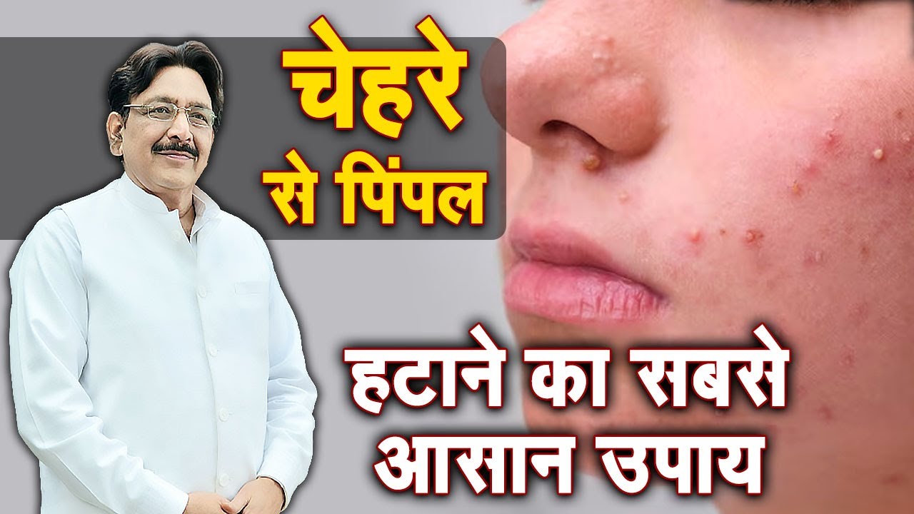 चेहरे से पिंपल हटाने का सबसे आसान उपाय | Hakim Suleman Khan | Sadhna TV