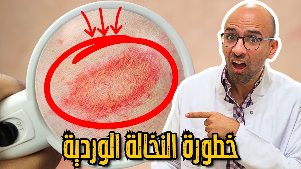 الطفح البمبي الذي حيَّر الاطباء 🤔 - النخالة الوردية