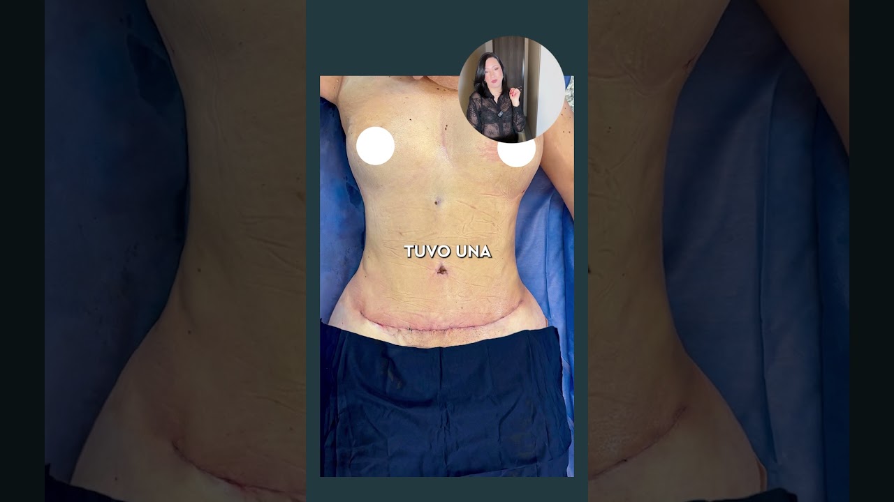 PARTE II de un incre&iacute;ble resultado de nuestra paciente #cirugiasplasticas #cirugiaplastica #tips