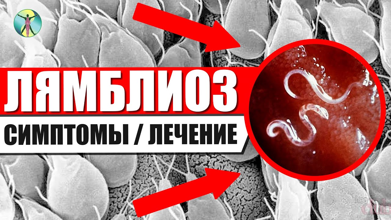 Лямблии у детей и взрослых!! Симптомы и лечение лямблиоза.