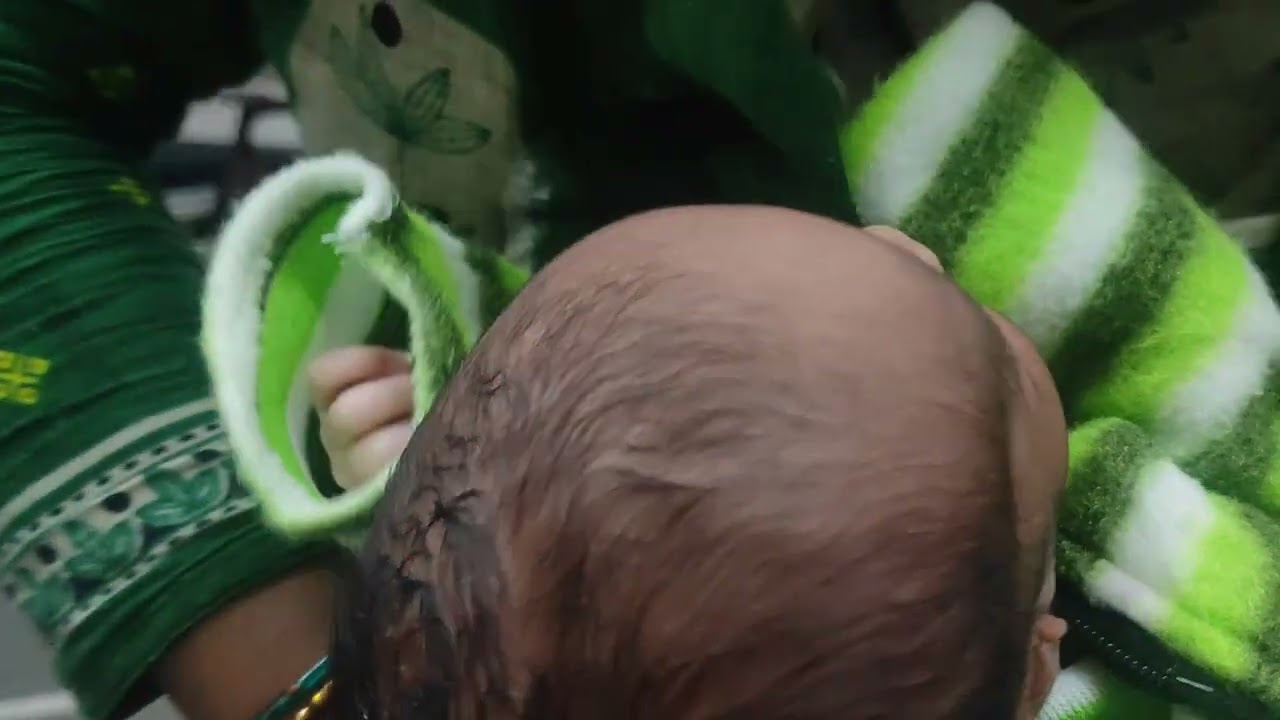 congenital malformation of new born ear. Malformed pina with pre -auricular tag.