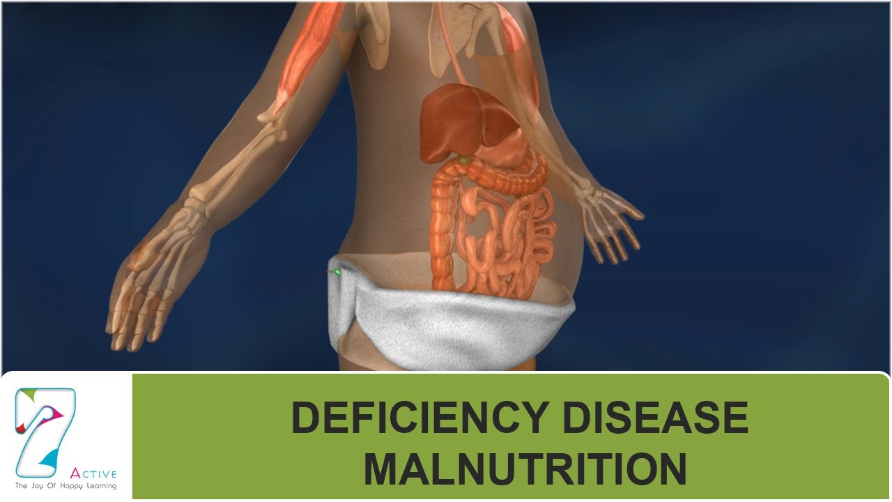 DEFICIENCY DISEASE : MALNUTRITION