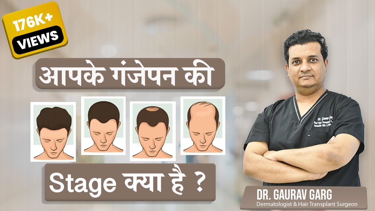 How to Recognize Your Grade of Baldness? | Stages of Male Pattern Baldness | Dr. Gaurav Garg