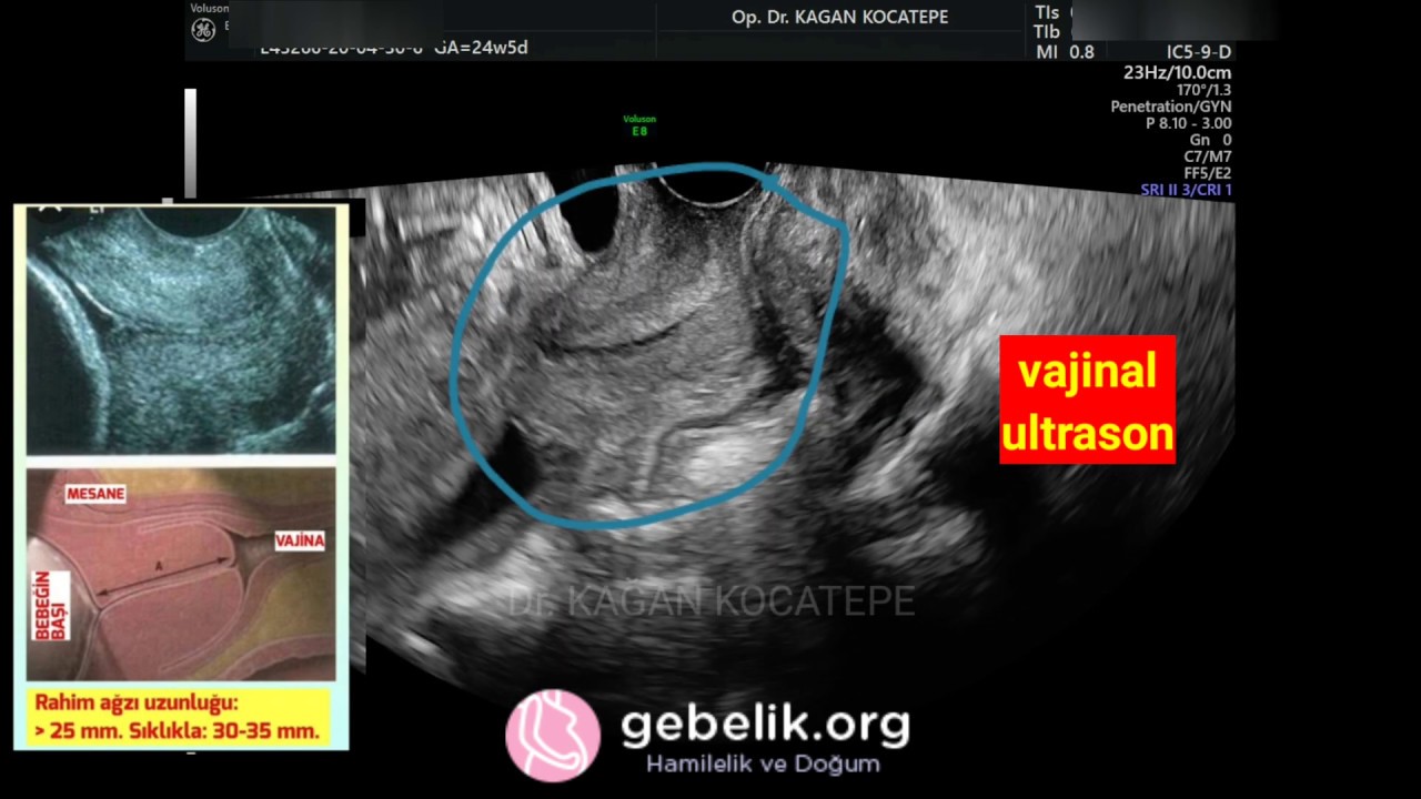 RAHİM AĞZI UZUNLUĞU VAJİNAL ULTRASON İLE NE ZAMAN VE NASIL ÖLÇÜLÜR? KAÇ MM. OLURSA ERKEN DOĞUM OLUR?