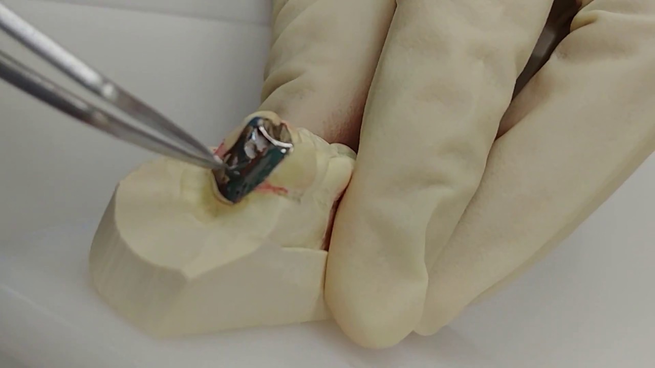 103  楊幽幽 為什麽脫了智慧牙仍然痛—牙齒敏感 (病例) Editor-in-chief Online Journal of Dentistry & Oral Health
