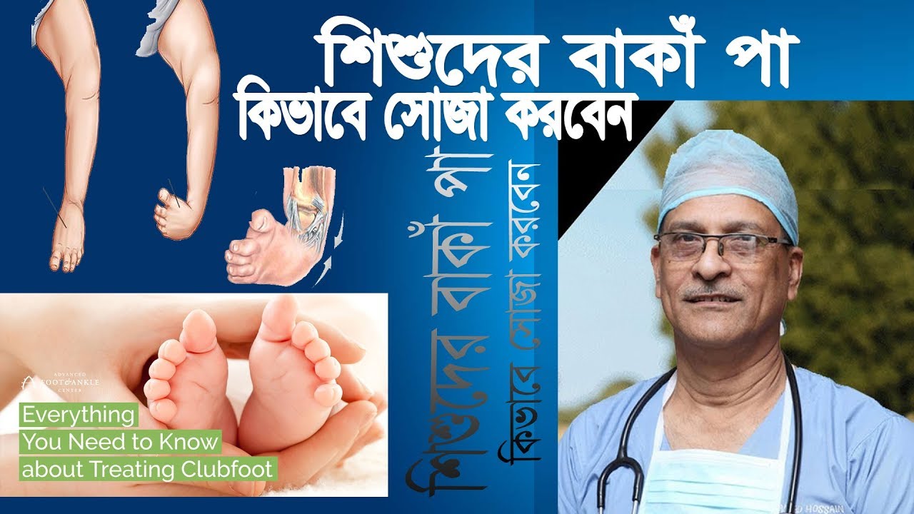 Club Foot Treatment-শিশুদের জন্মগত পা বাঁকার চিকিৎসা।Prof. Dr. M. Amjad Hossain