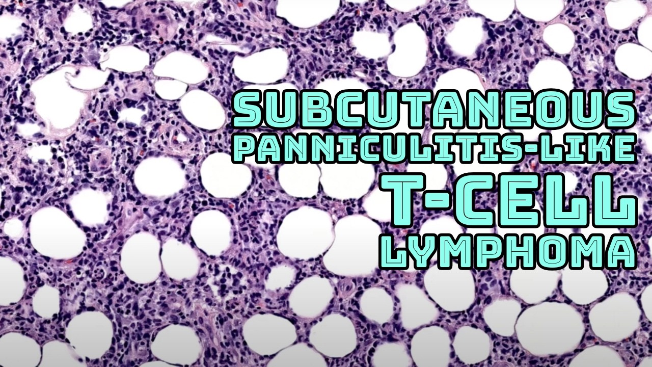 Subcutaneous panniculitis-like T-cell lymphoma (alpha beta T-cell lymphoma) pathology histology
