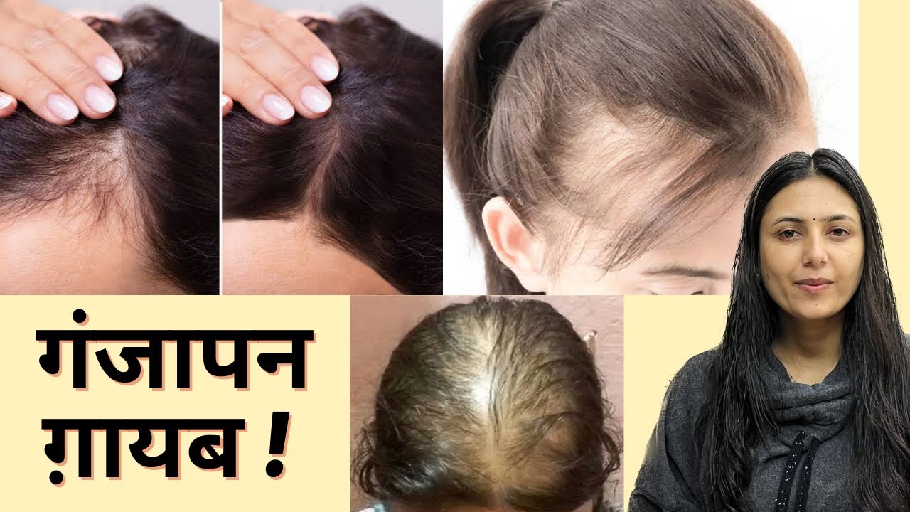 Lost Hair Growth Challenge : गायब होती Hairline को दोबारा उगायें | Stop Hair Loss & Regrow Lost Hair