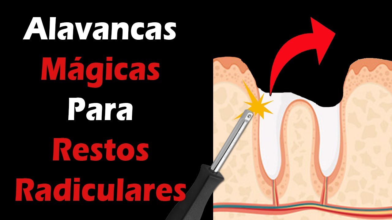 Descubra Como Extrair QUALQUER Raiz Residual - Alavancas Apexo - Exodontia Simples