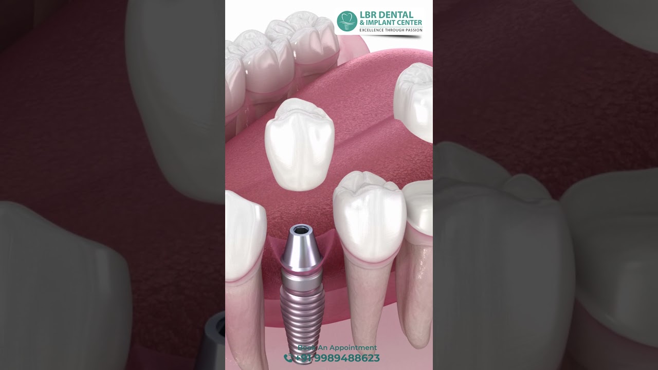 Don't Let Tooth Loss Change Your Face - Learn How to Keep Your Muscles Balanced! Best Dental Clinic