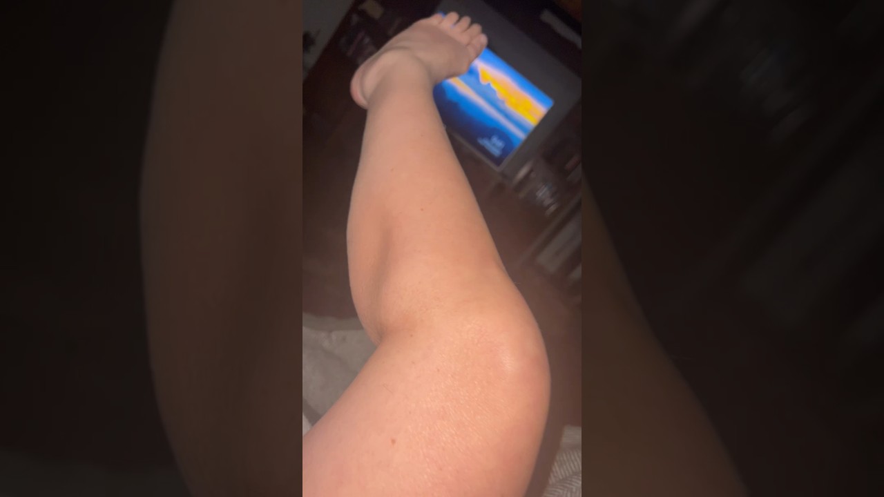 I think this is muscle atrophy or wasting on my left calf from ALS