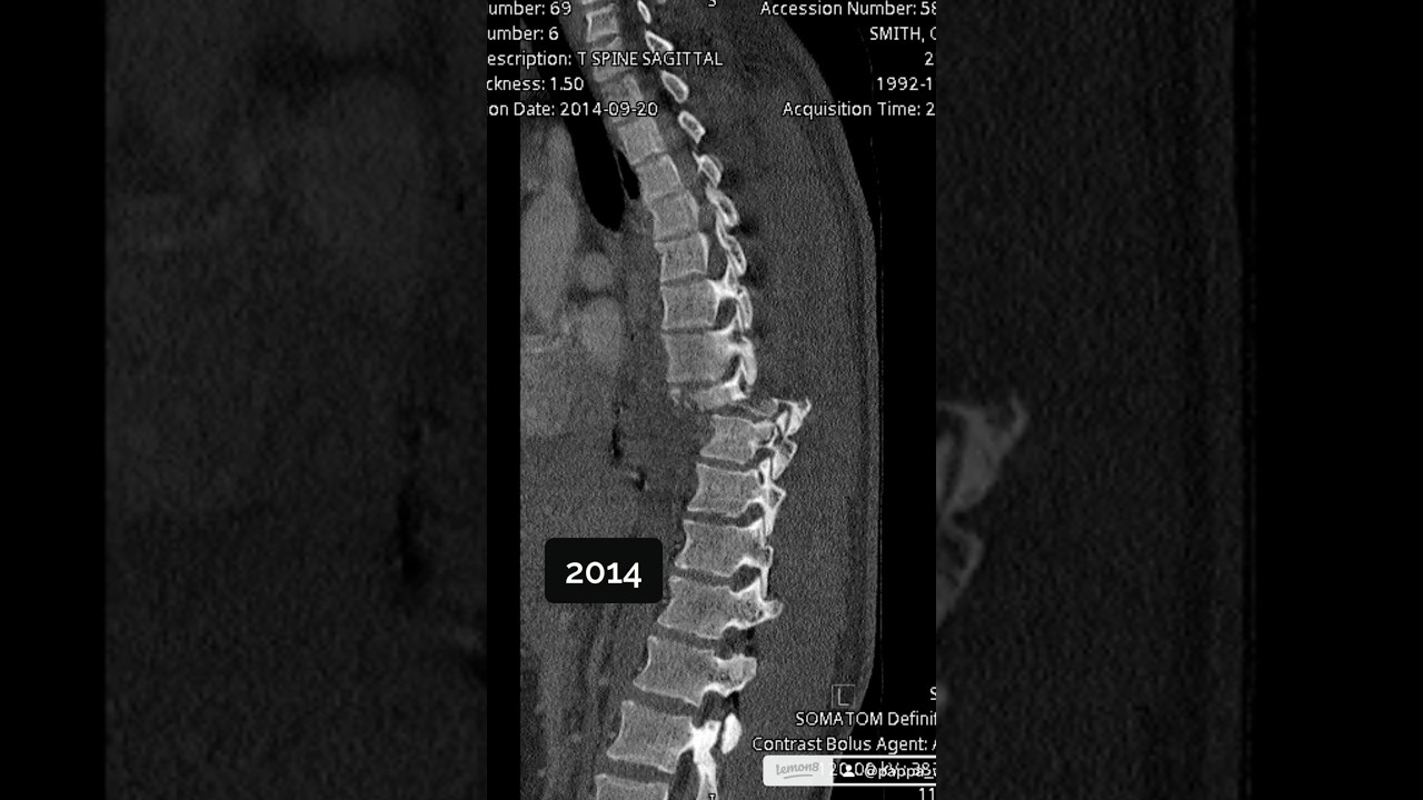 Show and tell #xray #spinalcordinjury #brokenarm #wheelchair #showandtell #viralvideo #injury