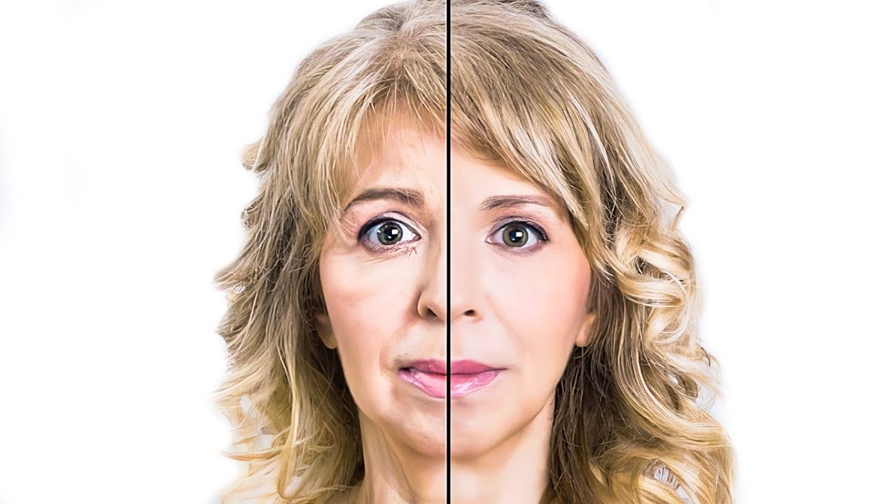 First Time Filler & Botox - Should You Do It?