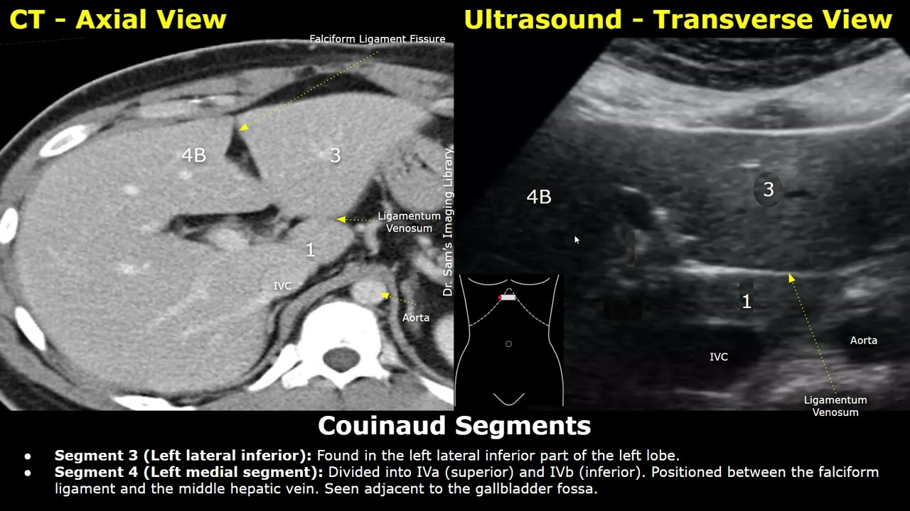 Couinaud Classification of Liver Segments On Ultrasound & CT Scan | Liver Anatomy USG Probe Position