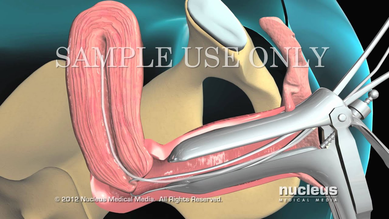 Biopsia endometrial