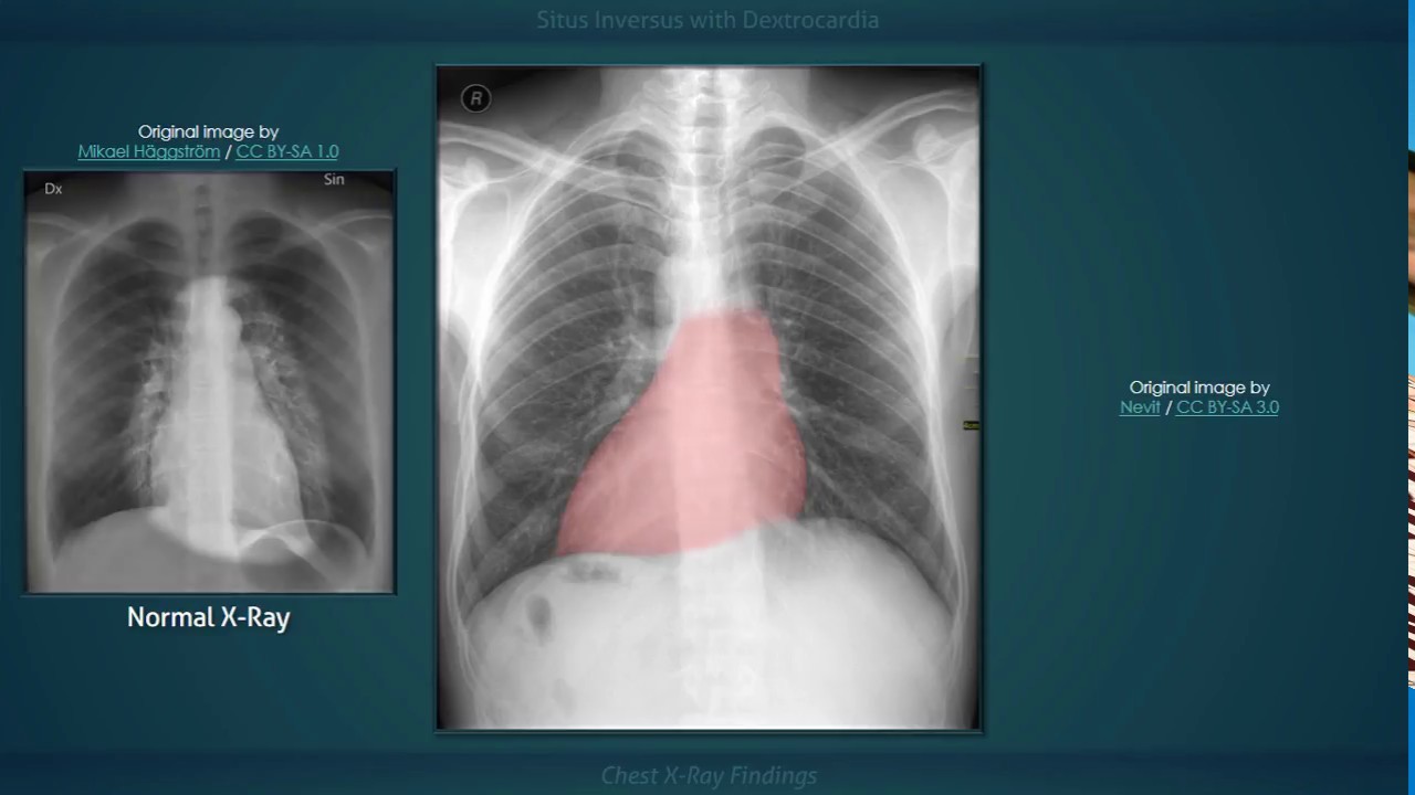 Situs Inversus with Dextrocardia: Explanation of Chest X-ray Findings