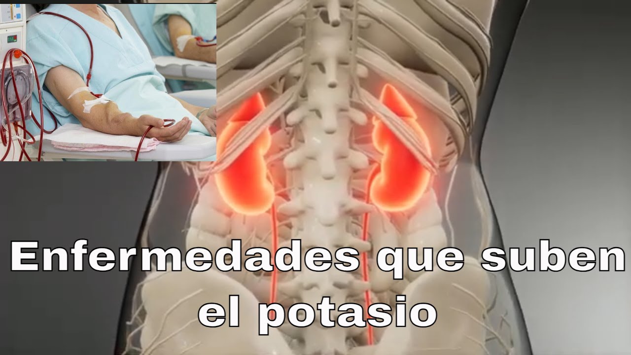 5 Enfermedades que suben el potasio. Parte 3/4