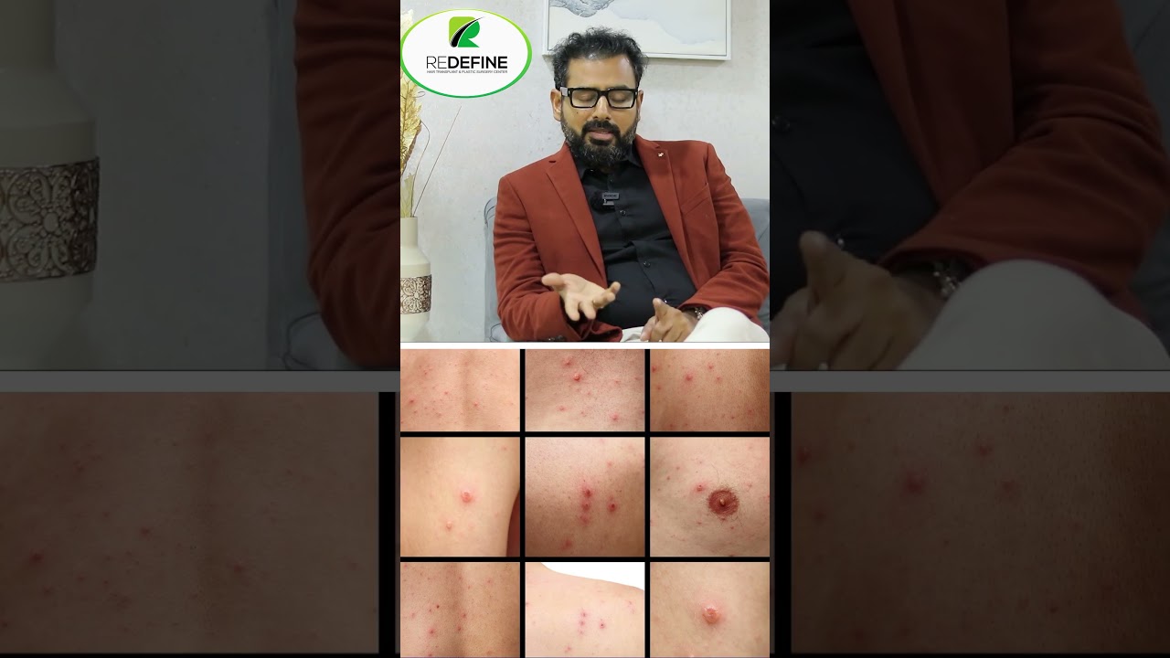 Permanent solution for chicken pox spots || How to Remove Chicken Pox Spots from Face