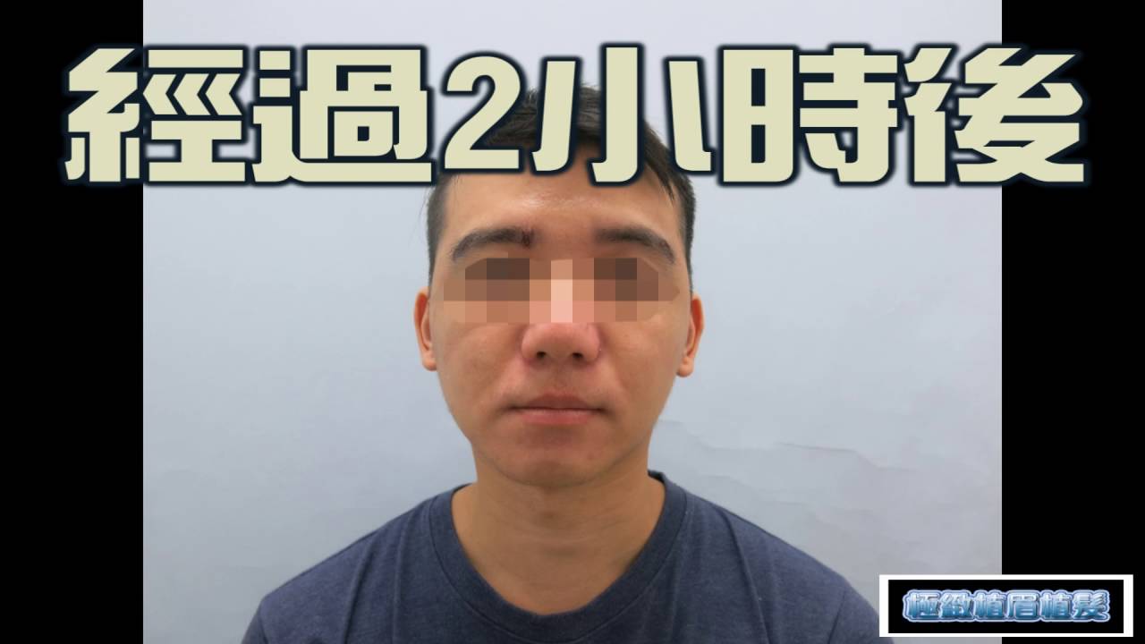 植眉改造 植眉手術全紀錄 林子鈞醫師主治-極緻美型&middot;文心極緻皮膚科診所整形手術-林子鈞醫師：台中植眉_微創植眉_植眉手術流程_植眉手術案例_植眉價格