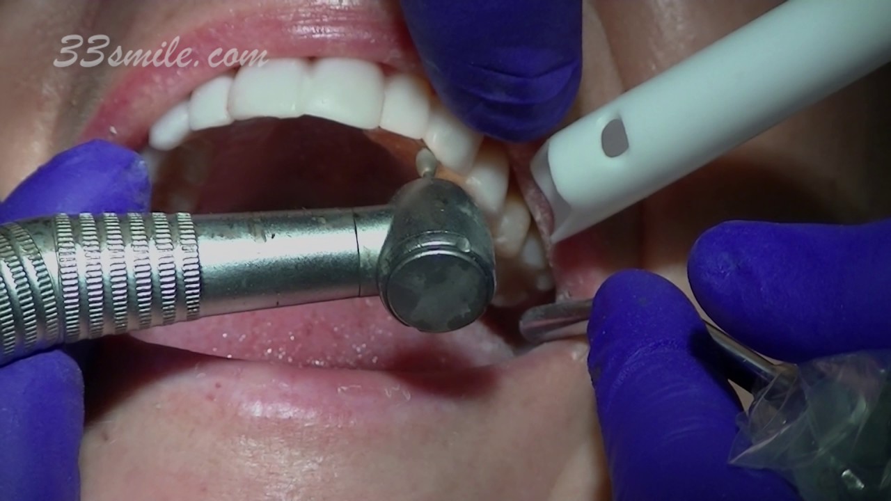 Porcelain Veneers from Cosmetic Dental Associates in San Antonio, TX