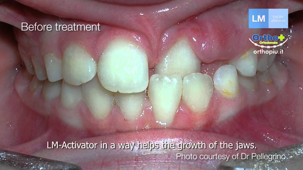 LM Activator - video [ENG]