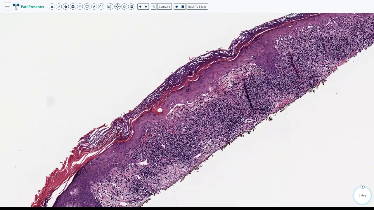 Lecture 3-Lichenoid Interface Dermatitis