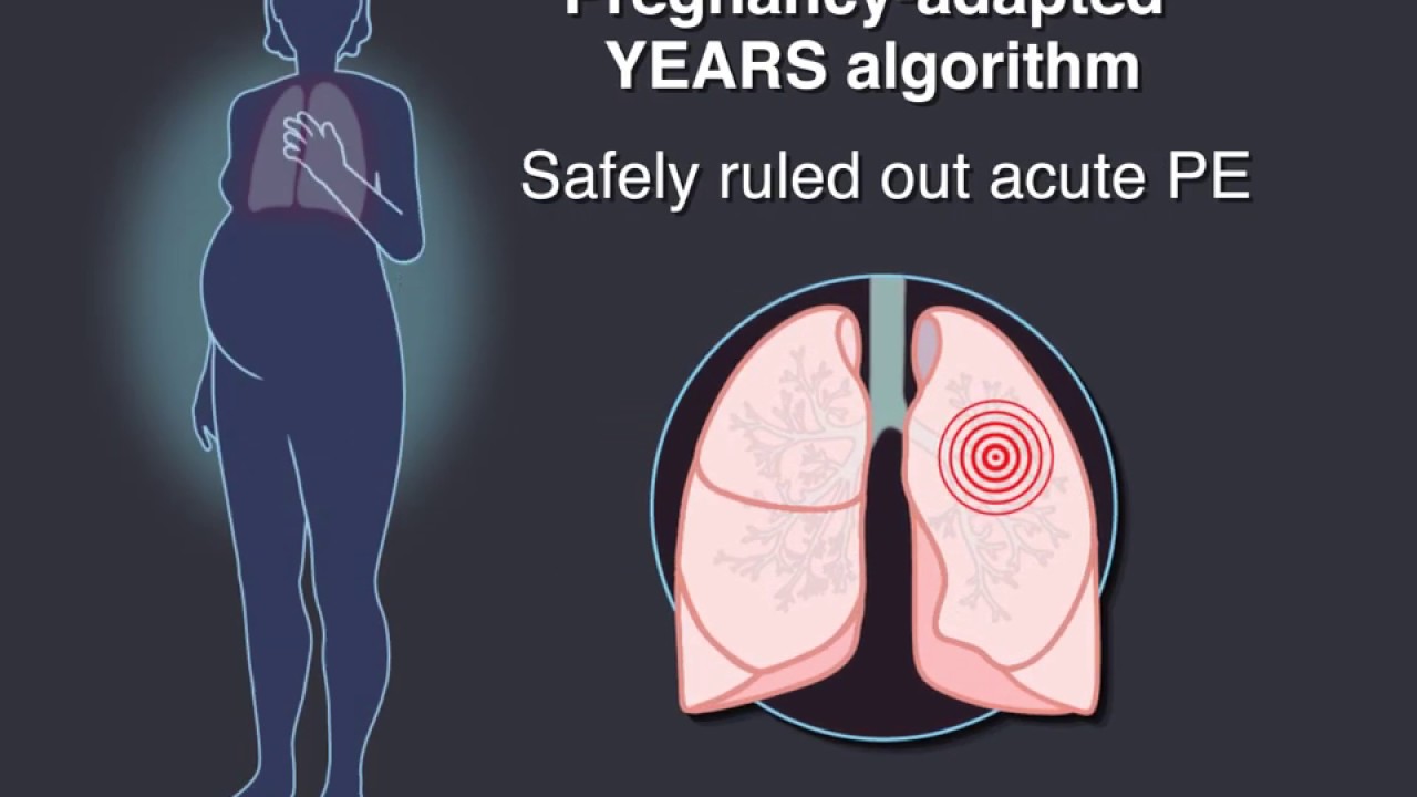 Pulmonary Embolism and Diagnostic CT in Pregnancy