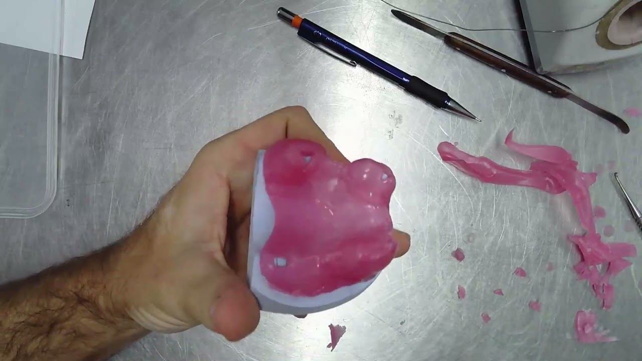 Maxillary partial denture customised tray