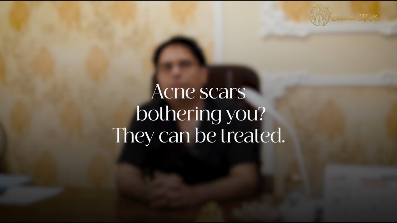 Acne Scars Treatment Explained | Acne Scars Ka Best Treatment Kya Hai?