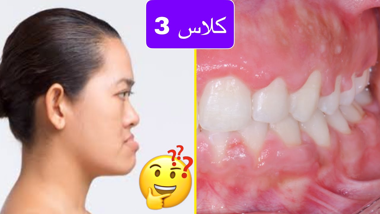 ضب الفك السفلي 
