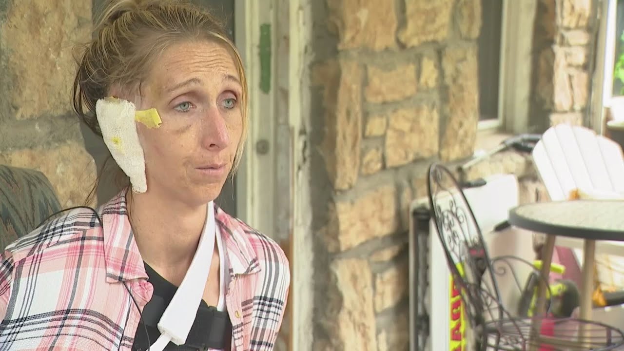 Kansas City Costco hit-and-run victim speaks out