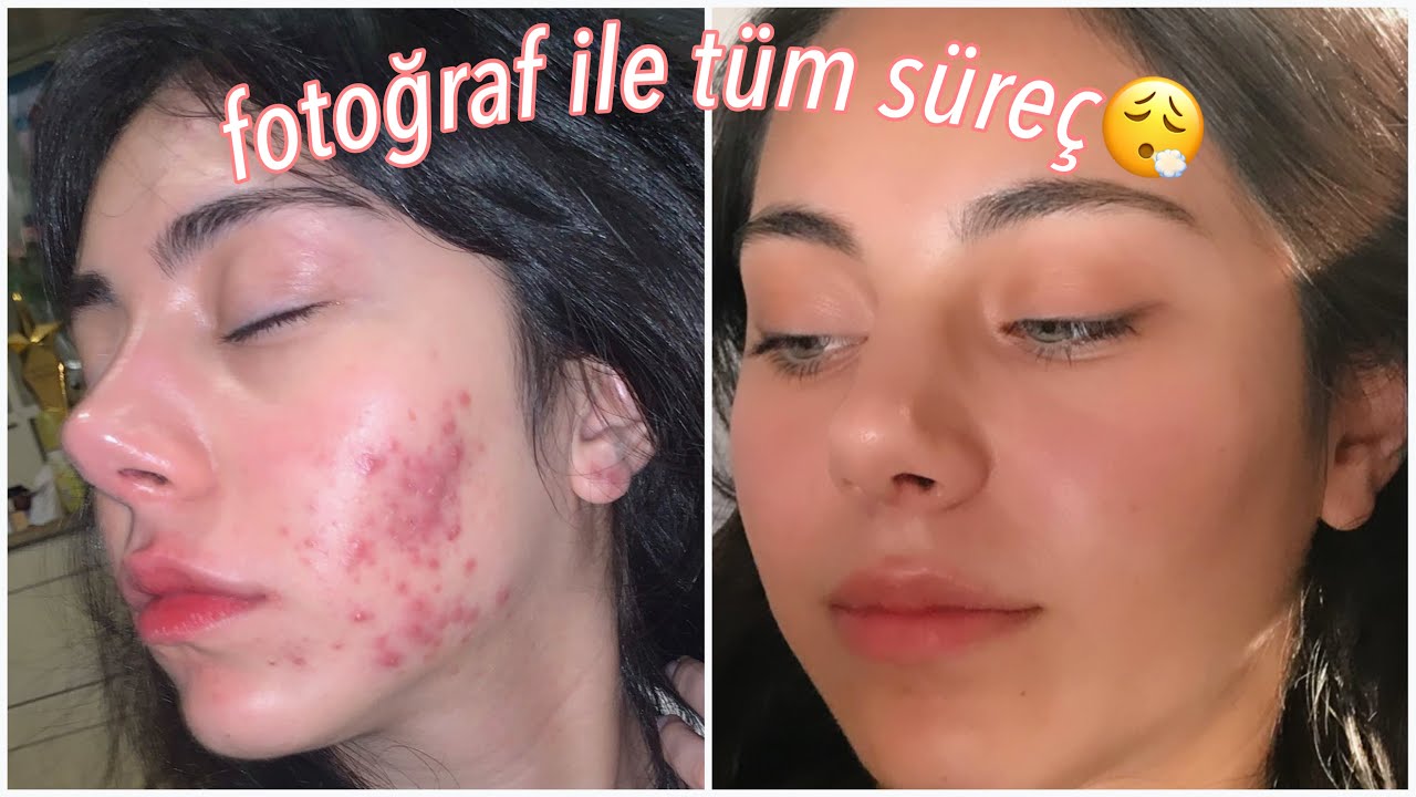 Fotoğraflı Roaccutane Sürecim🥵🧖🏻‍♀️ Sivilce Tedavisi✨