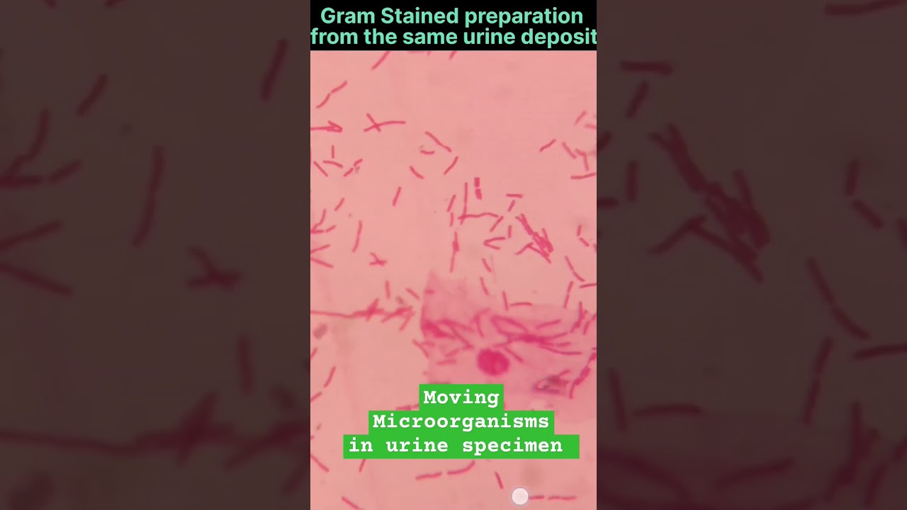 MOVING MICROORGANISM IN URINE DEPOSIT / GNB ON GRAM STAINING OF URINE DEPOSIT 