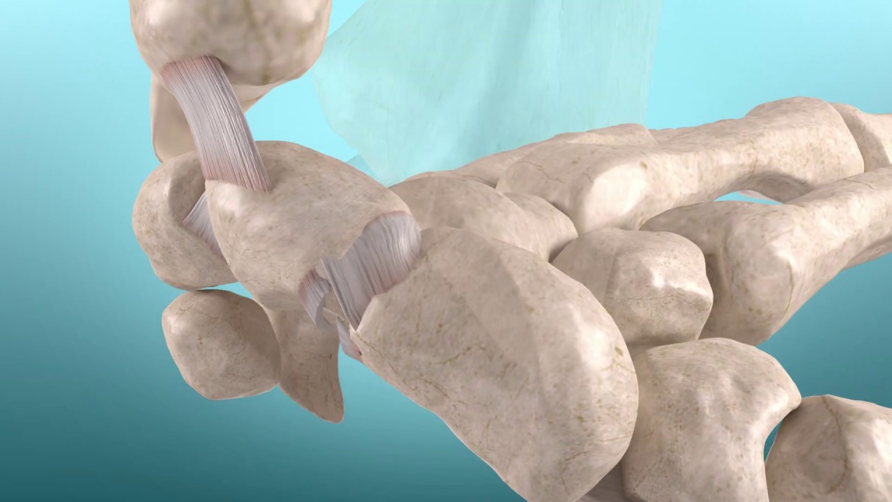 Carpal Instability DISI and VISI deformity 3D