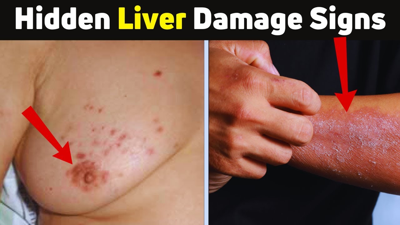 12 Weird Signs That Show You're Having Liver Damage