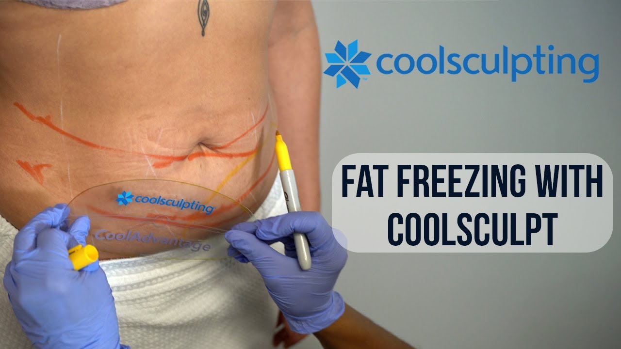 CoolSculpting (Fat Freezing) Procedure | West End Plastic Surgery