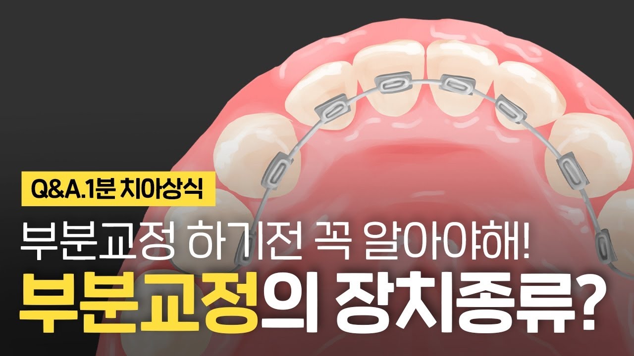 부분교정 교정장치 종류? 앞니 부분치아교정 투명, 설측, 2D, 티끌, MTA 도 가능해! ⏰1분 치아상식!!