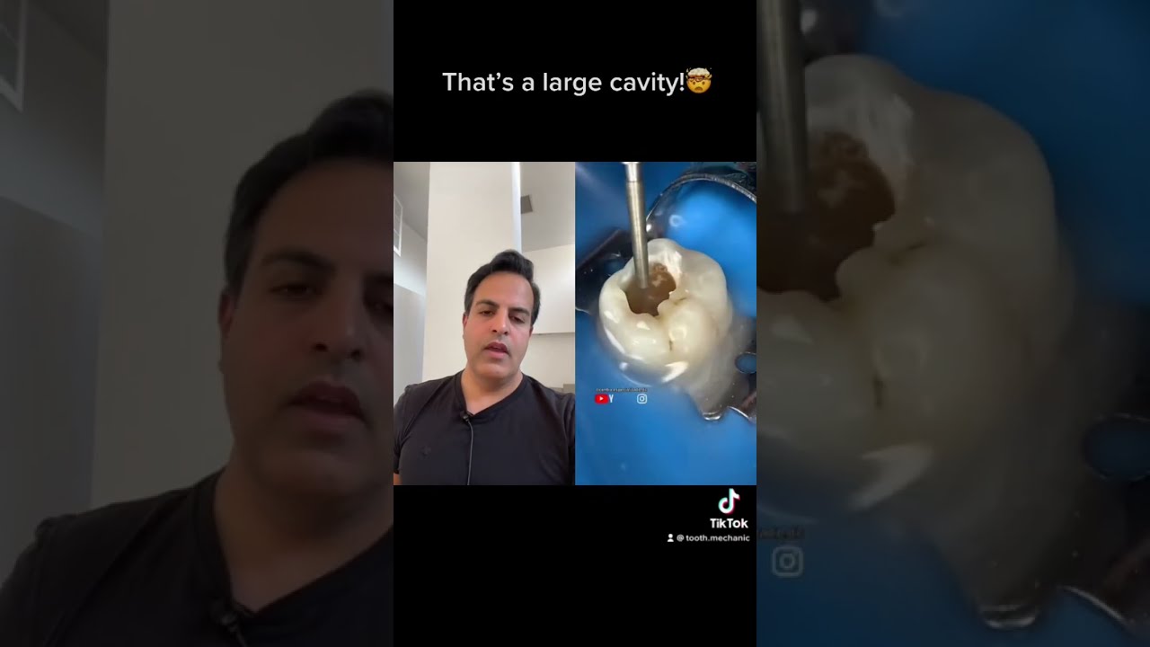 one of the LARGEST cavities i have seen🤯