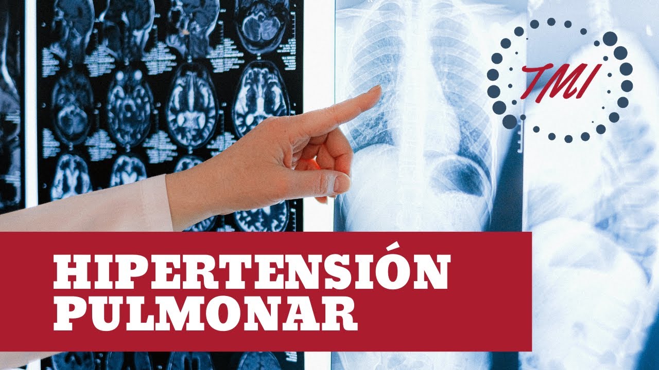 Hipertensión Pulmonar