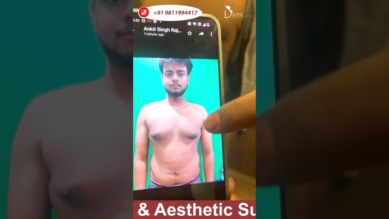 Are you Worried about Scar After Gynecomastia Surgery? After Gynecomastia Treatment | Patient Review